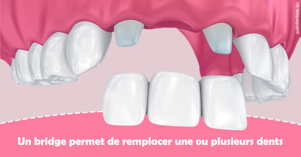 https://dr-nathalie-lambert.chirurgiens-dentistes.fr/Bridge remplacer dents 2