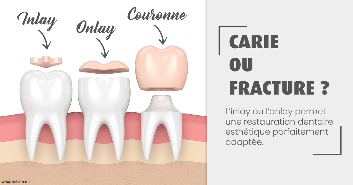 https://dr-nathalie-lambert.chirurgiens-dentistes.fr/T2 2023 - Carie ou fracture 1