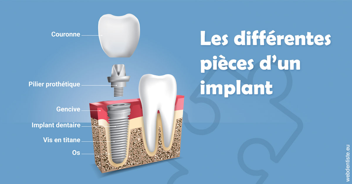 https://dr-nathalie-lambert.chirurgiens-dentistes.fr/Les différentes pièces d’un implant 1